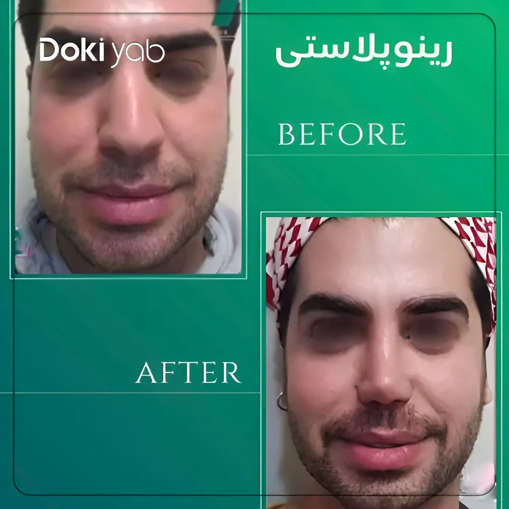 نتیجه عمل دماغ زنانه توسط دکتر محمودرضا اصحاب یمین