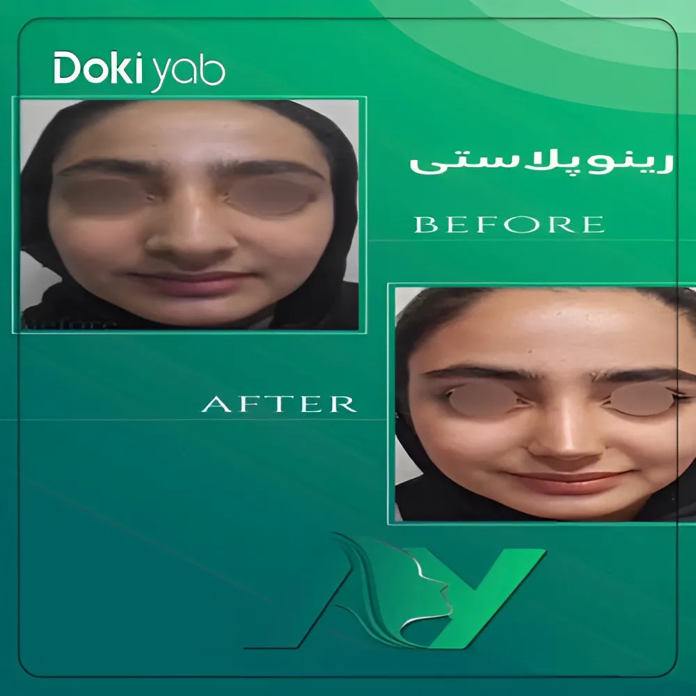 نتیجه عمل بینی یک خانم قبل و بعد از جراحی توسط دکتر محمودرضا اصحاب یمین