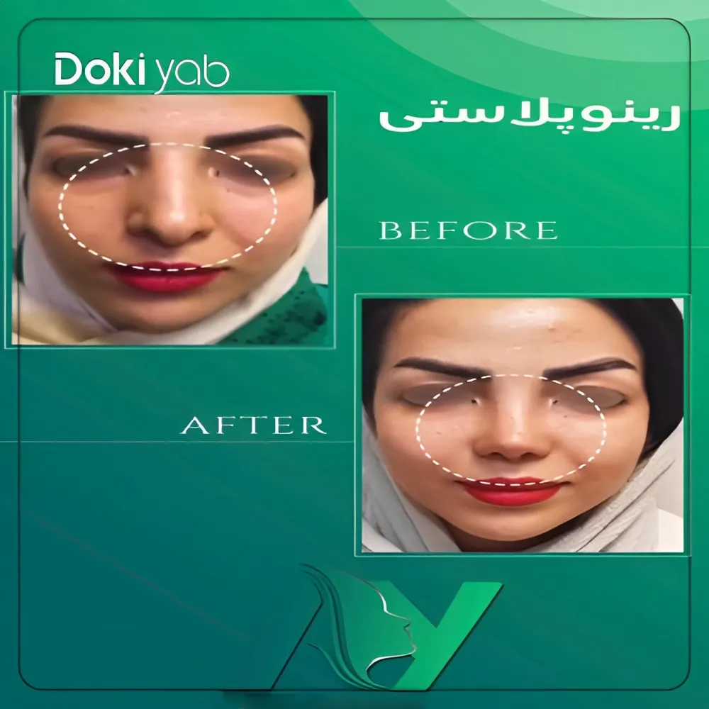نمونه عمل دماغ دخترانه قبل و بعد از جراحی توسط دکتر محمودرضا اصحاب یمین
