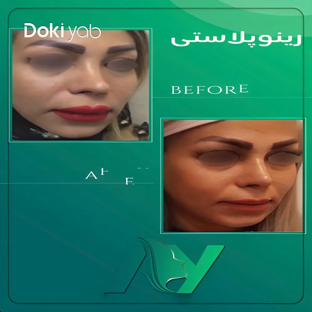 نتیجه رینوپلاستی یک خانم قبل و بعد از عمل توسط دکتر محمودرضا اصحاب یمین