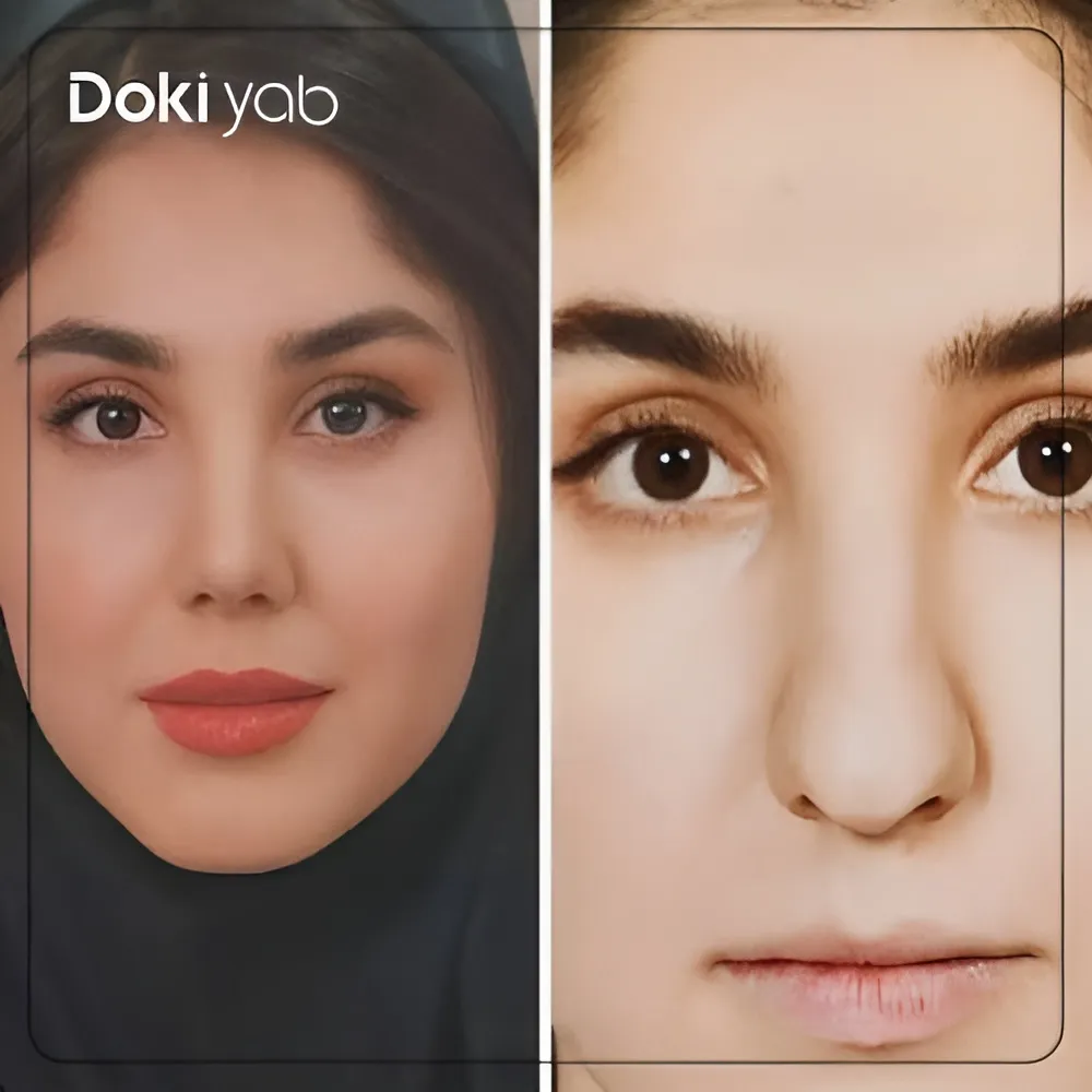 نمونه جراحی بینی گوشتی دخترانه توسط دکتر محسن بهادر قبل و بعد از عمل
