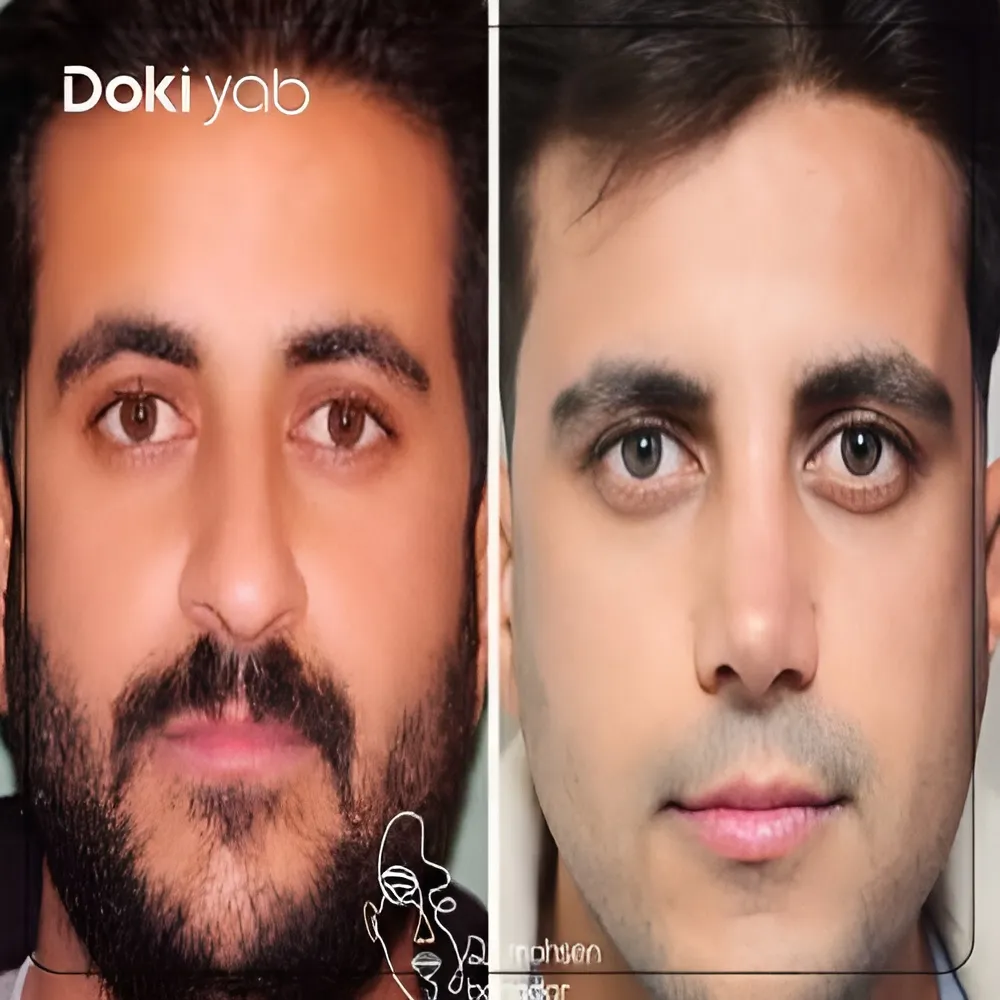 مقایسه فرم بینی مردانه قبل و بعد از عمل توسط دکتر محسن بهادر