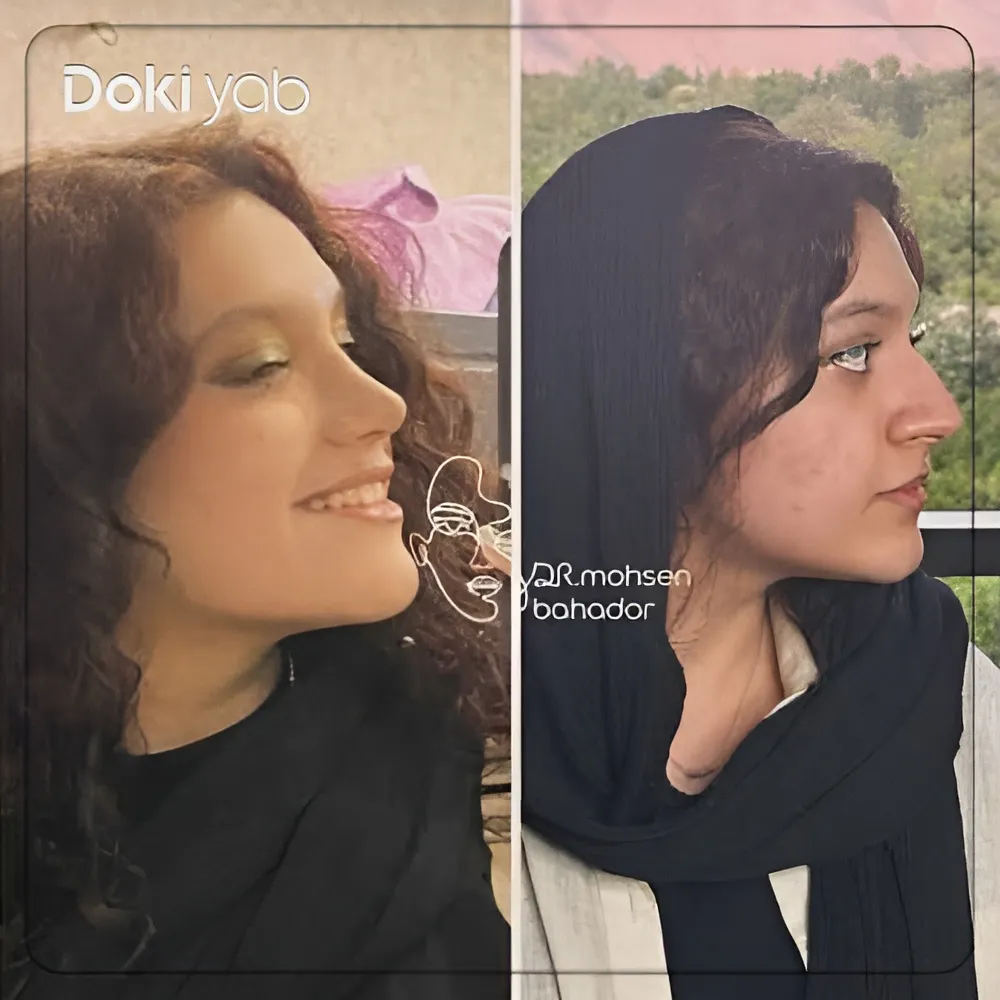 نمونه عمل دماغ دخترانه توسط دکتر محسن بهادر