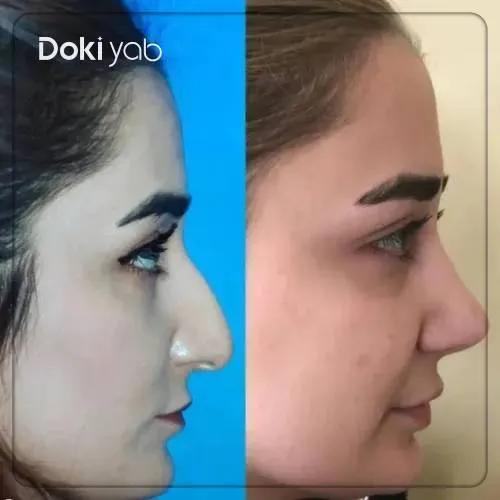 نتیجه عمل بینی طبیعی زنانه دکتر مجتبی نادیان