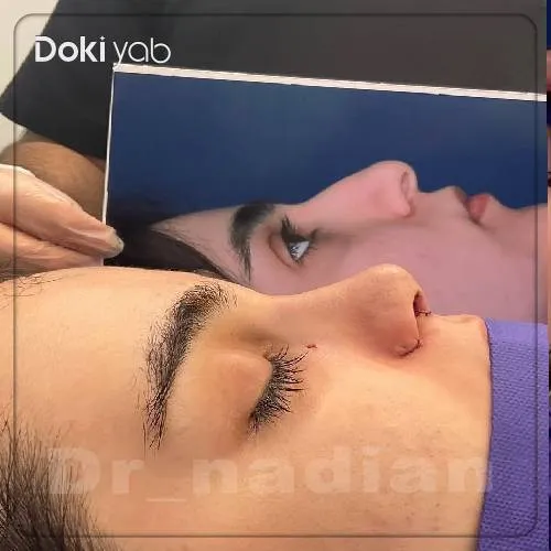 نمونه کار جراحی بینی دکتر مجتبی نادیان