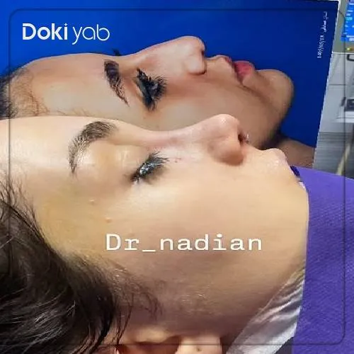 نمونه رینوپلاستی نیمه فانتزی دکتر مجتبی نادیان قبل و بعد از عمل